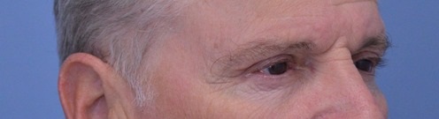 Blepharoplasty