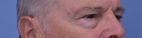 Blepharoplasty