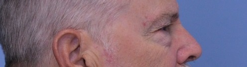 Blepharoplasty