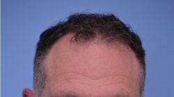 Hair Transplant