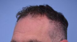 Hair Transplant