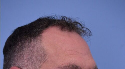 Hair Transplant