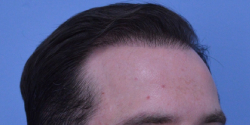 Hair Transplant