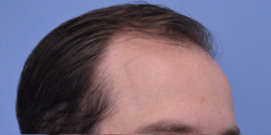 Hair Transplant