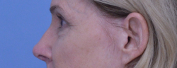 Rhinoplasty
