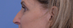 Rhinoplasty