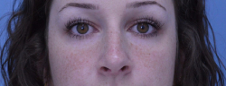 Rhinoplasty