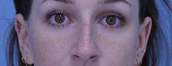 Rhinoplasty