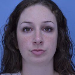 Rhinoplasty