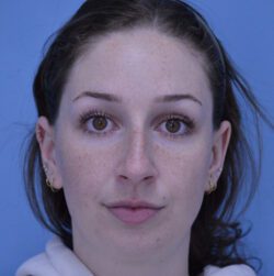 Rhinoplasty