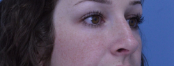 Rhinoplasty