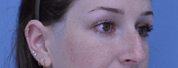 Rhinoplasty