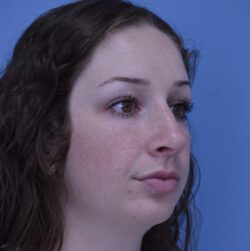 Rhinoplasty