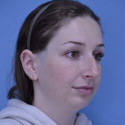 Rhinoplasty