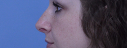 Rhinoplasty