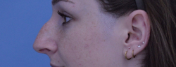 Rhinoplasty
