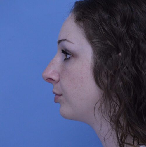 Rhinoplasty