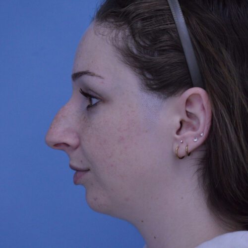 Rhinoplasty