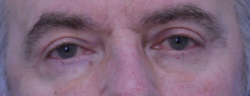Blepharoplasty