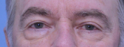 Blepharoplasty