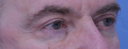 Blepharoplasty