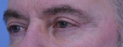 Blepharoplasty