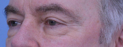 Blepharoplasty