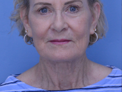 Facelift & Neck Lift