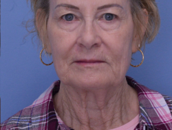 Facelift & Neck Lift