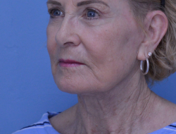 Facelift & Neck Lift