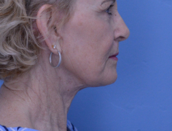 Facelift & Neck Lift