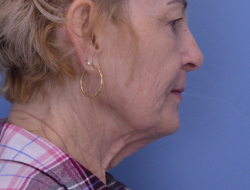 Facelift & Neck Lift