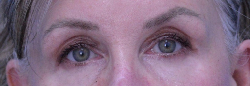 Endoscopic Brow Lift