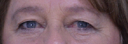 Endoscopic Brow Lift