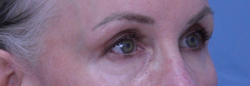 Endoscopic Brow Lift
