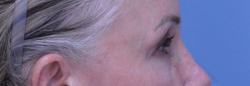 Endoscopic Brow Lift
