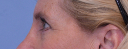 Blepharoplasty