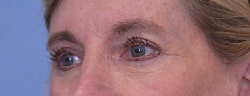 Blepharoplasty Case 40577 After Photo Blepharoplasty