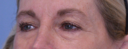Blepharoplasty Case 40577 Before Photo Blepharoplasty