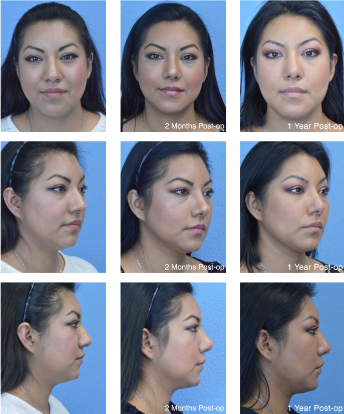 Ethnic rhinoplasty before and after photo progression