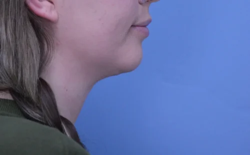 Chin Augmentation