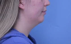 Chin Augmentation