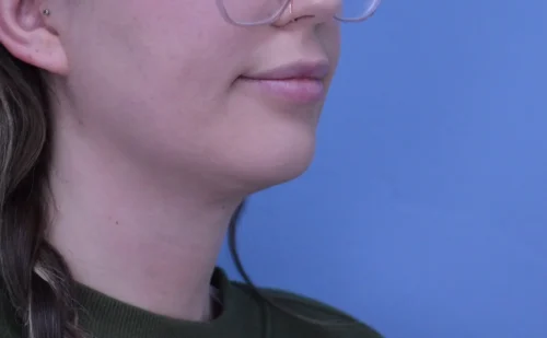 Chin Augmentation