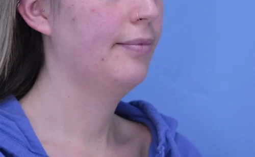 Chin Augmentation