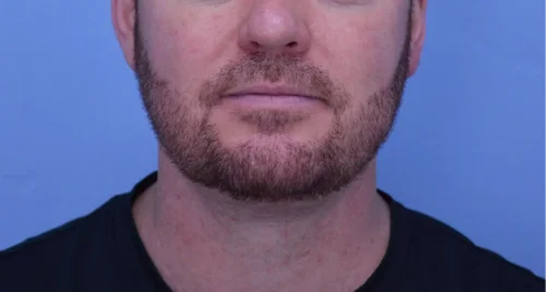 Facelift & Neck Lift