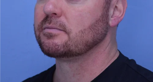 Facelift & Neck Lift