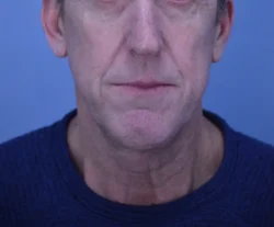 Facelift & Neck Lift