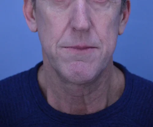 Facelift & Neck Lift