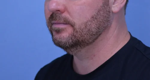 Facelift & Neck Lift