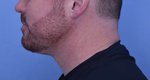 Facelift & Neck Lift